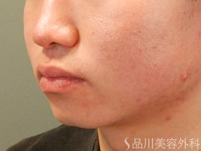 症例NO.70245のBEFORE写真