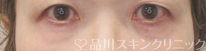 症例NO.70908のAFTER写真