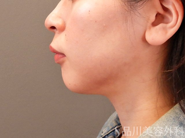 症例NO.69954のBEFORE写真