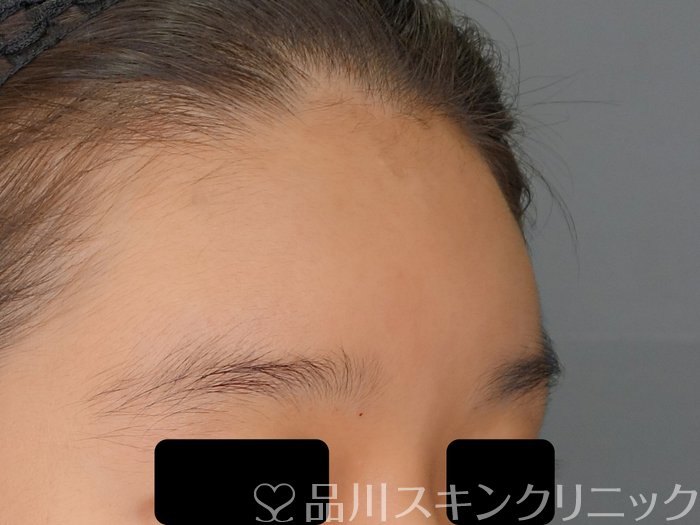 症例NO.70829のAFTER写真