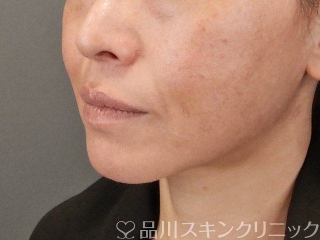 症例NO.75298のBEFORE写真