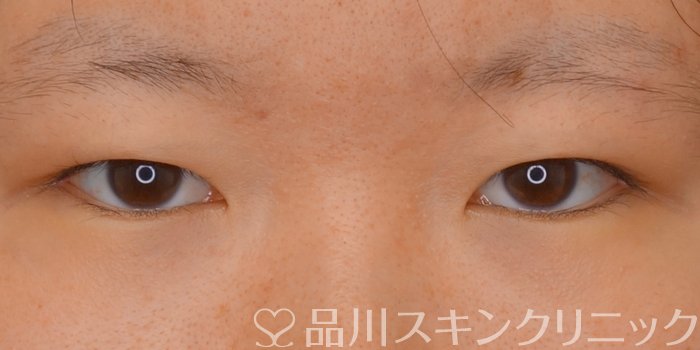 症例NO.71543のBEFORE写真