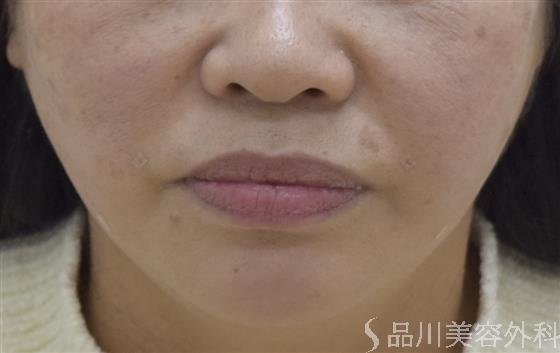 症例NO.47630のAFTER写真