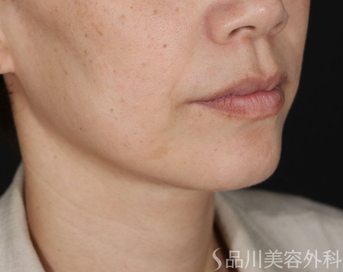 症例NO.71701のBEFORE写真