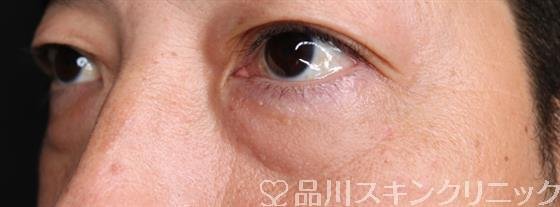 症例NO.55008のBEFORE写真