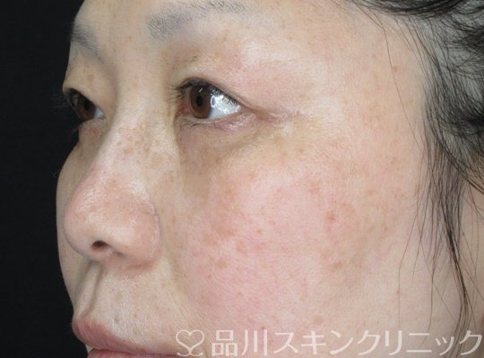 症例NO.69728のAFTER写真