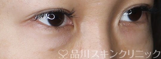 症例NO.70053のBEFORE写真