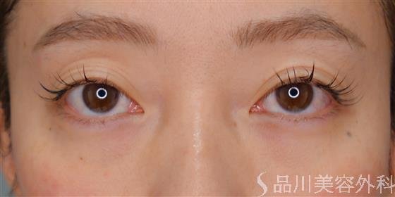 症例NO.54995のBEFORE写真