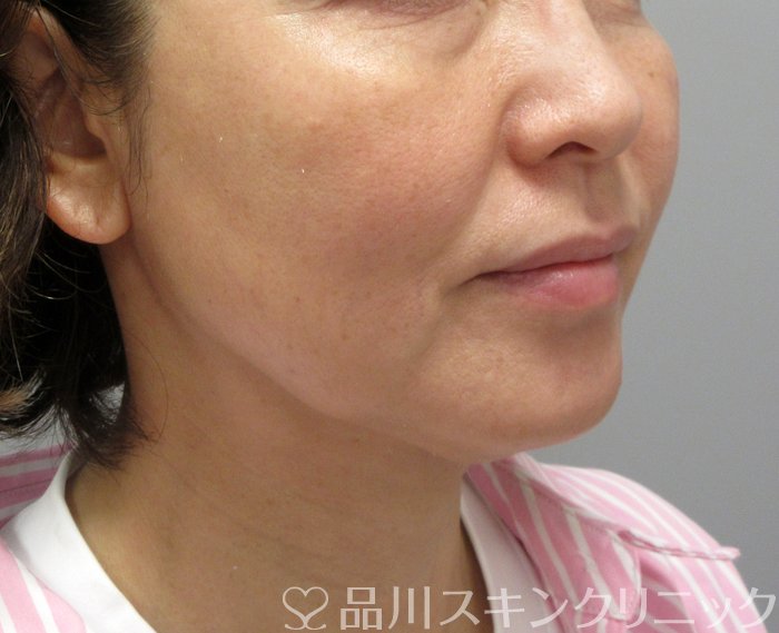 症例NO.73738のAFTER写真