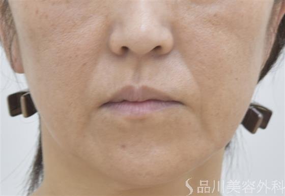 症例NO.46599のBEFORE写真