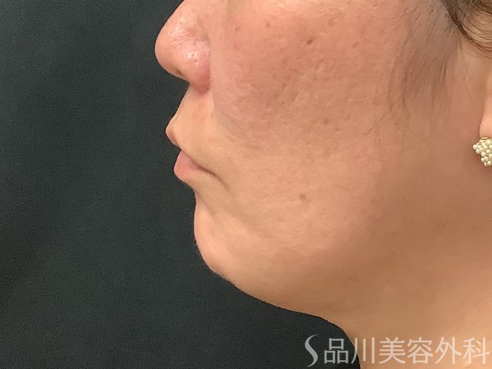 症例NO.67791のBEFORE写真