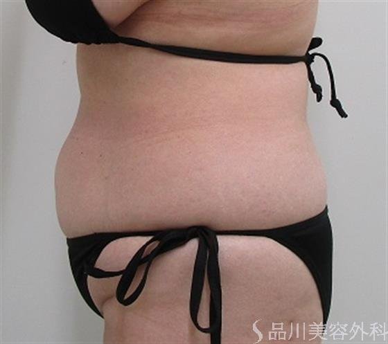 症例NO.42338のAFTER写真