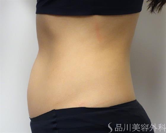 症例NO.44704のBEFORE写真