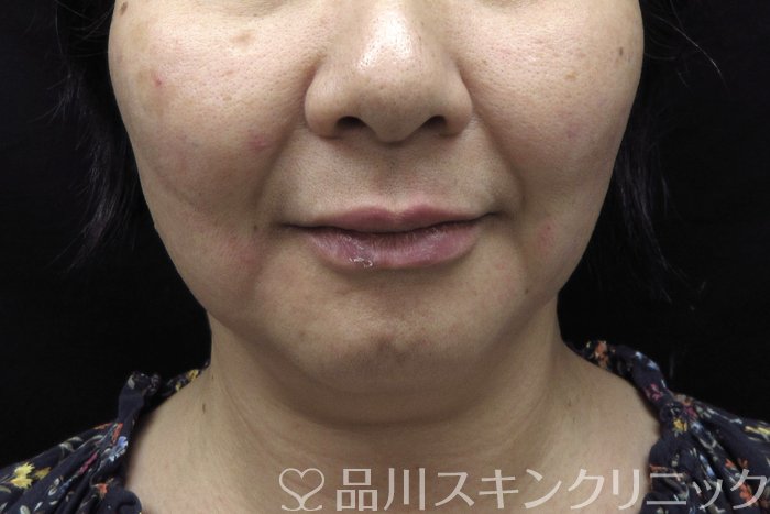 症例NO.74457のAFTER写真