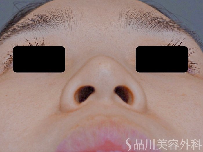 症例NO.74962のBEFORE写真