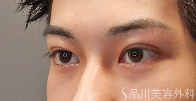 症例NO.74603のAFTER写真
