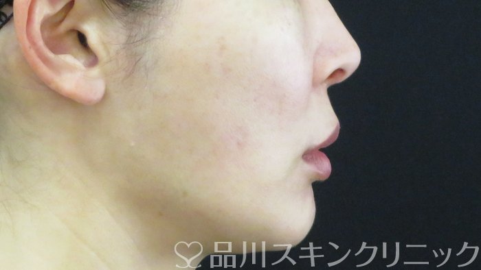 症例NO.71427のBEFORE写真