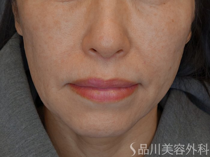 症例NO.73951のBEFORE写真
