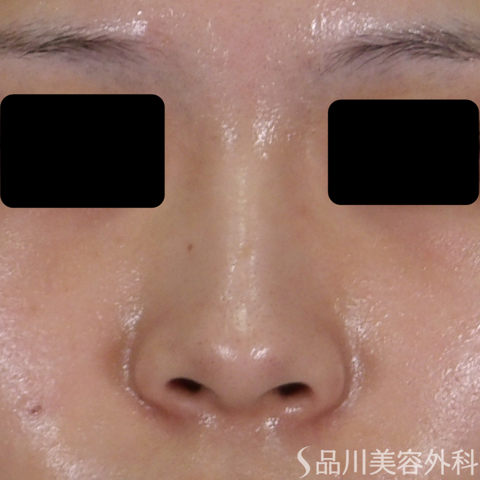 症例NO.70926のBEFORE写真