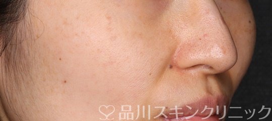 症例NO.74226のBEFORE写真