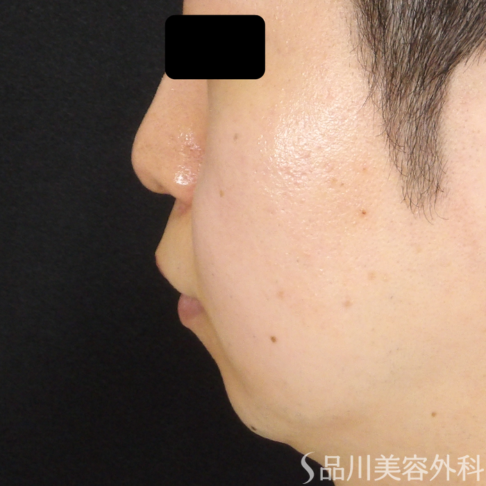 症例NO.71589のBEFORE写真