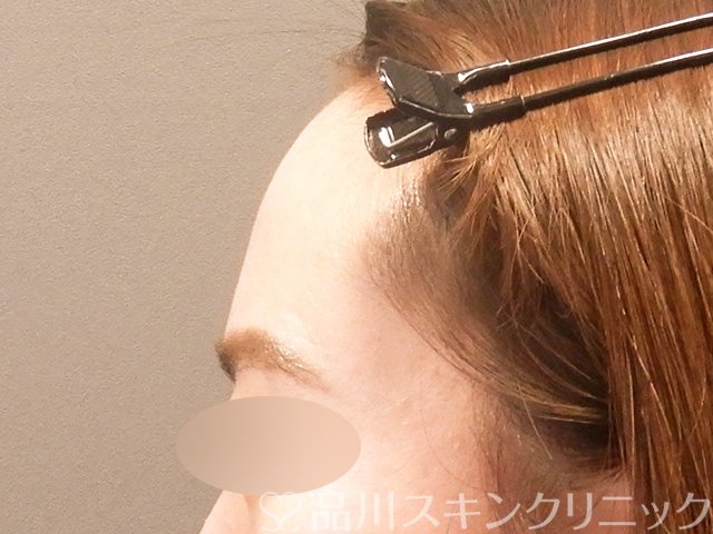 症例NO.70114のBEFORE写真