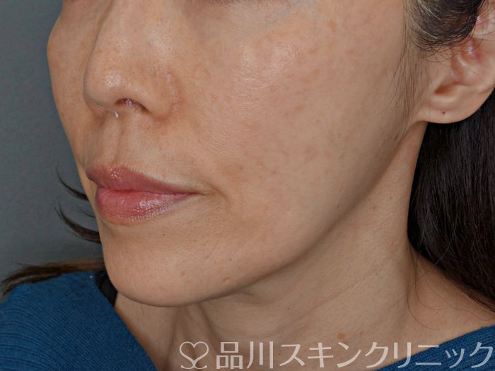 症例NO.73983のBEFORE写真