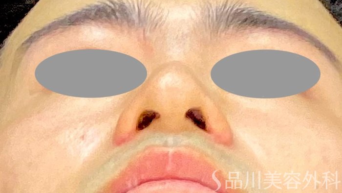 症例NO.71803のAFTER写真