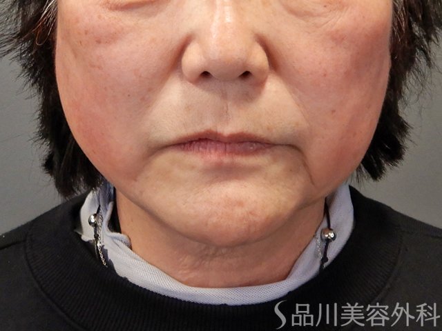 症例NO.74964のAFTER写真