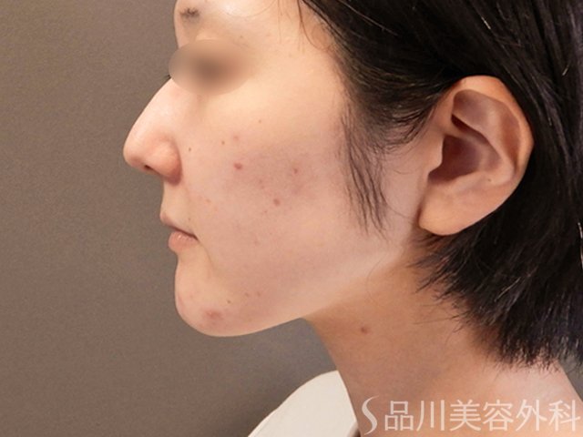 症例NO.65570のBEFORE写真