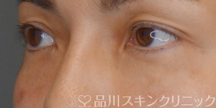症例NO.71007のAFTER写真