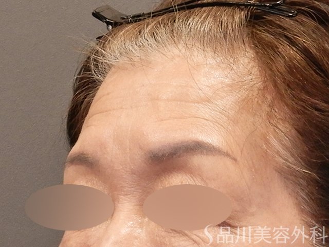 症例NO.72717のBEFORE写真