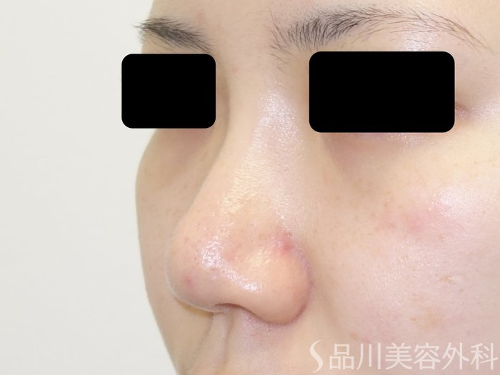 症例NO.69515のBEFORE写真