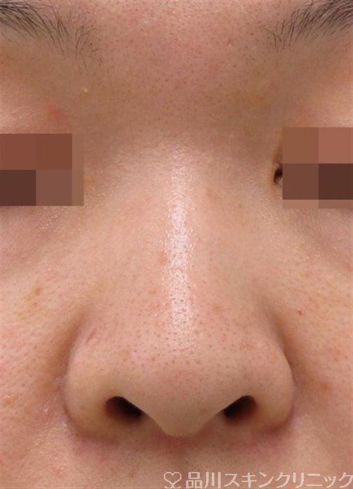 症例NO.36172のBEFORE写真