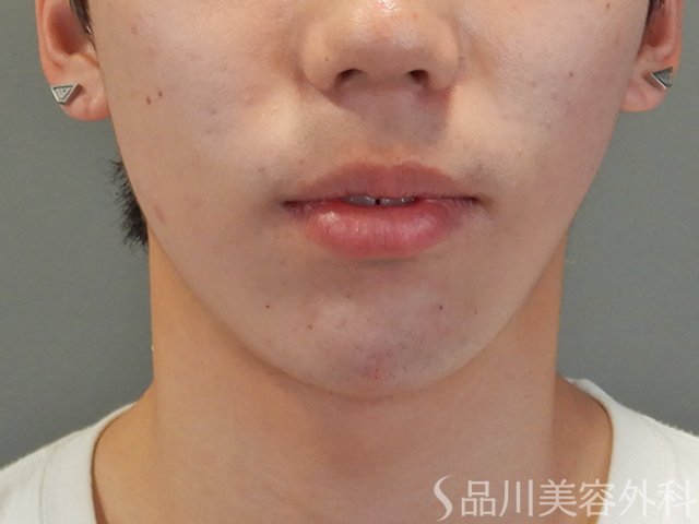 症例NO.74901のAFTER写真