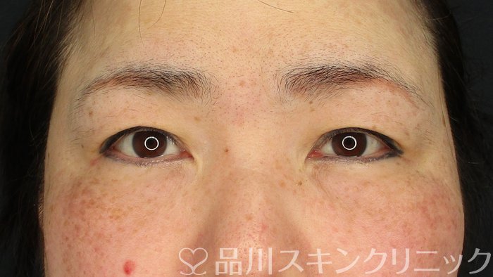 症例NO.63212のBEFORE写真