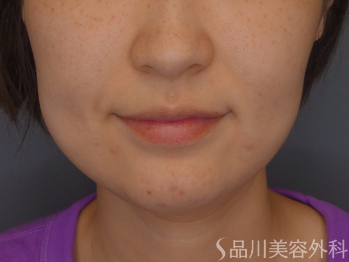 症例NO.67787のBEFORE写真