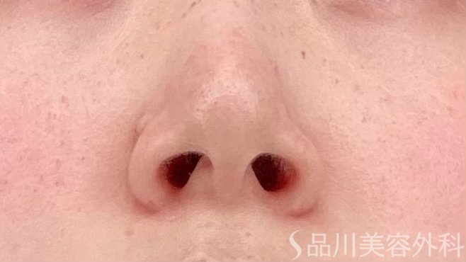 症例NO.64942のBEFORE写真