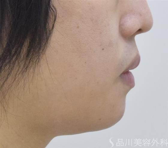 症例NO.47916のAFTER写真