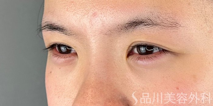 症例NO.70305のAFTER写真
