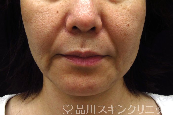 症例NO.74320のBEFORE写真
