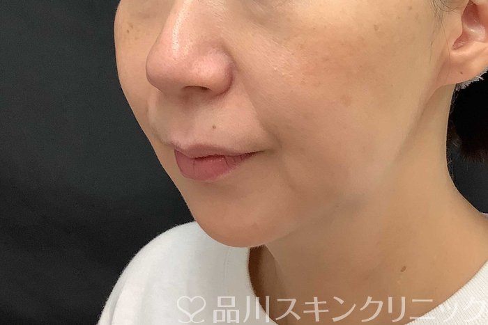 症例NO.69779のAFTER写真