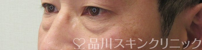 症例NO.73726のBEFORE写真