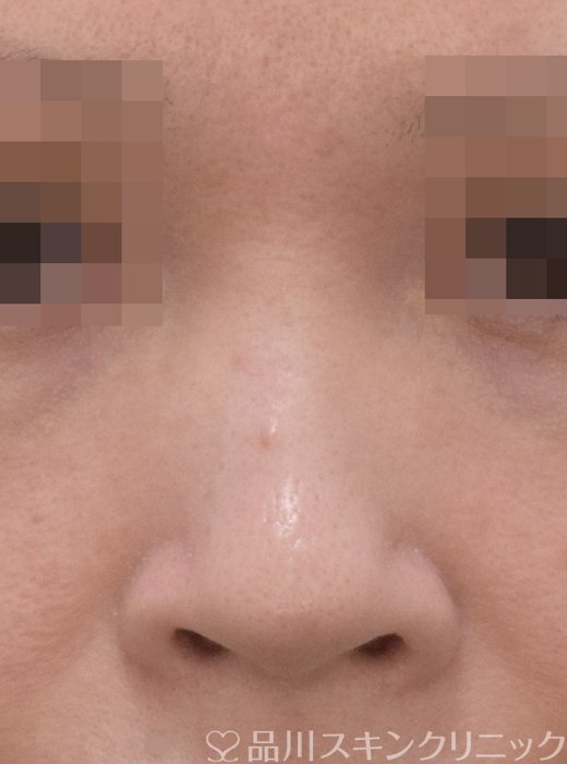 症例NO.71680のBEFORE写真