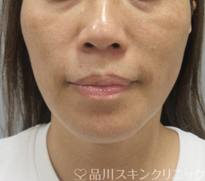 症例NO.71729のAFTER写真