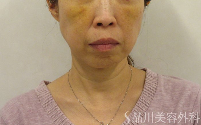 症例NO.72525のBEFORE写真