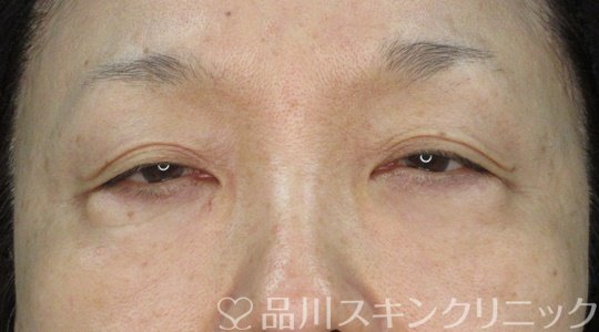 症例NO.72242のBEFORE写真