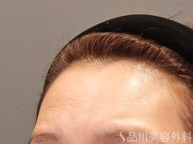 症例NO.73970のBEFORE写真