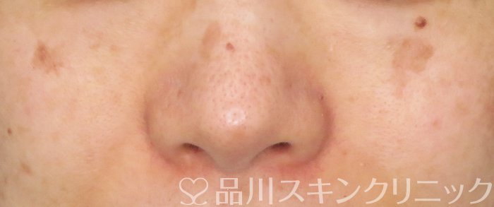 症例NO.64406のBEFORE写真