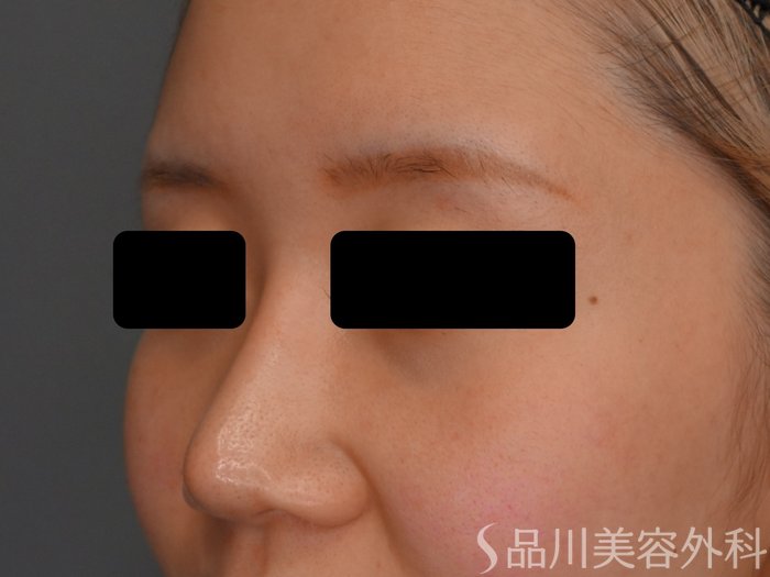 症例NO.73395のBEFORE写真